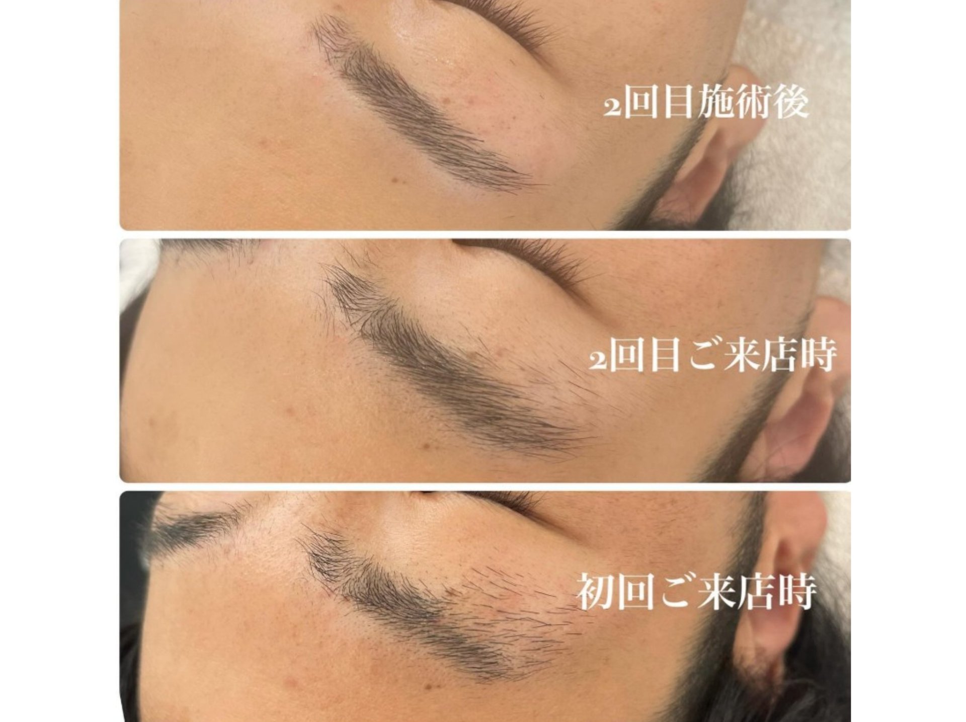 施術回数を重ねることでキレイに！