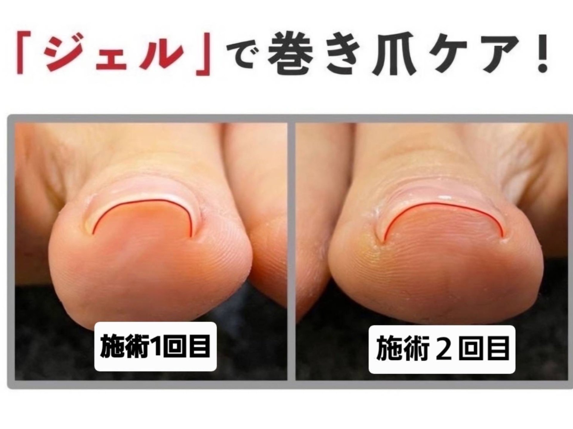 【HeySwitch】巻き爪のお悩み解消！